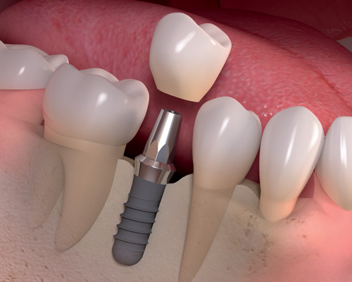 Dental Implants Berryville, VA